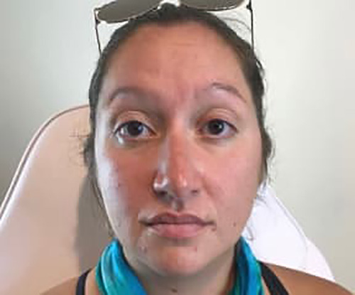 After Image: Botox - front